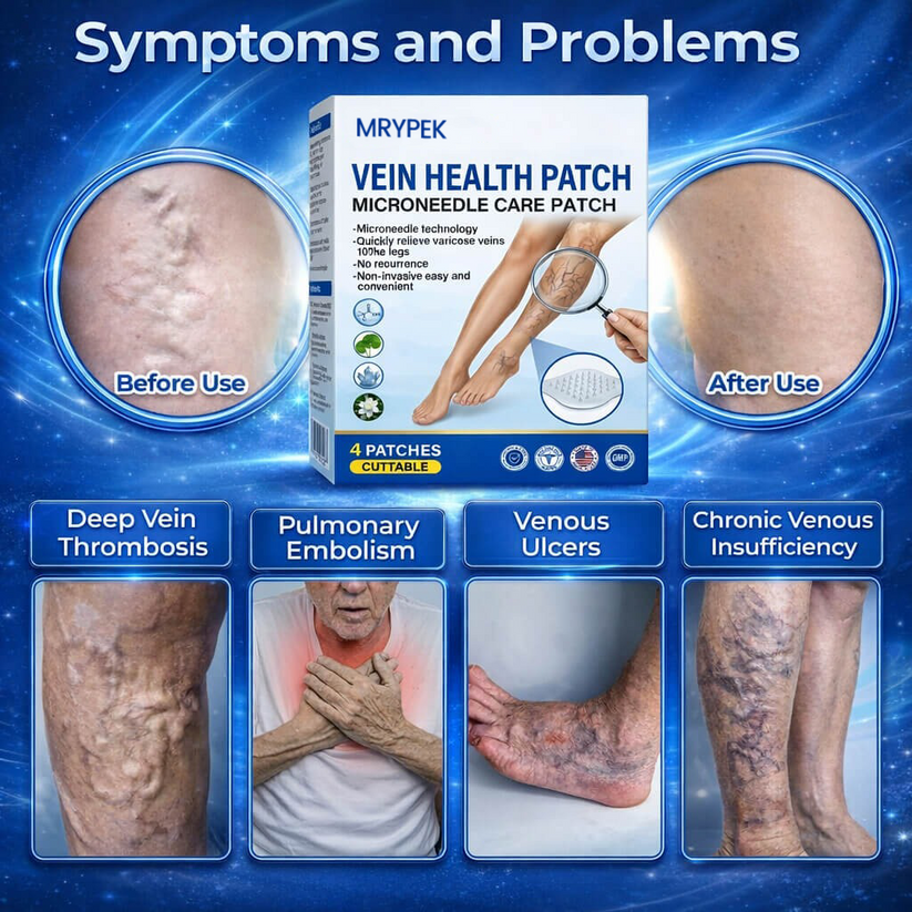 Varicose vein progression illustration